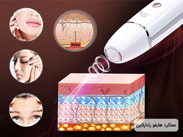 دستگاه رادالاین Radar line V Cavring RF Professional