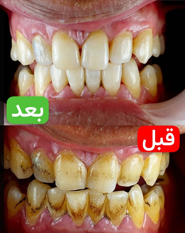 قیمت پودر جرم گیری وسفید کننده دندان اونیس 15گرمی unnis